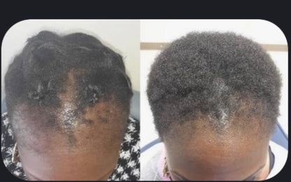 Before and after results from using the Hair Growth & Repair Kit showing improved hair thickness and scalp health.