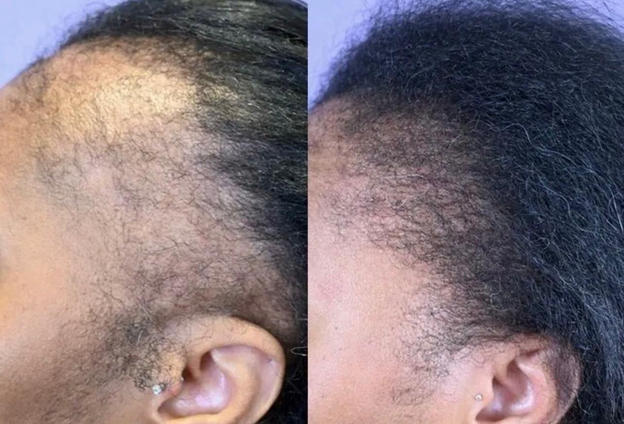 Before and after results of Hair Growth & Repair Kit showing improved hair fullness and scalp health.